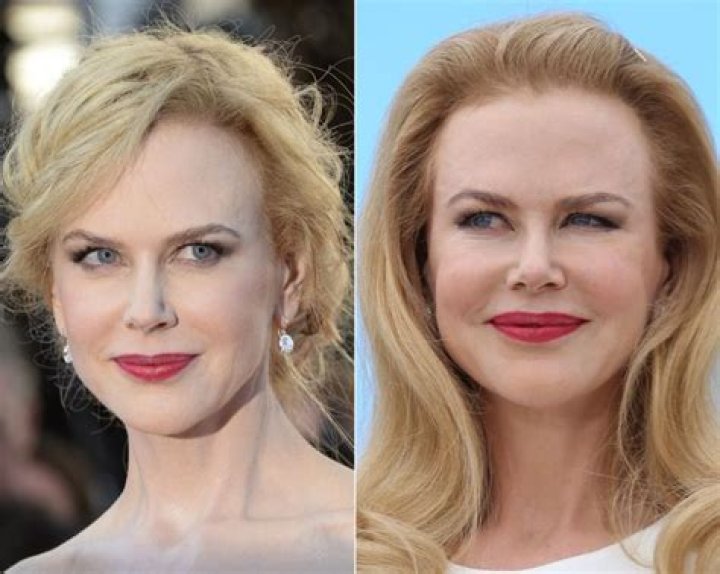 Nicole Kidman Plastic Surgery Before After Pics