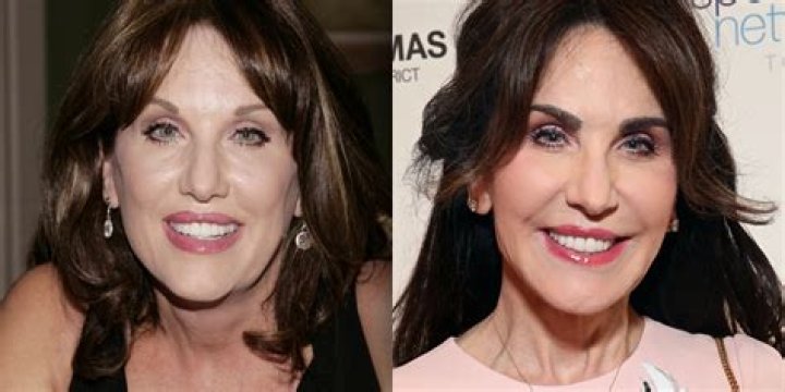 Robin McGraw cosmetic surgery rumours