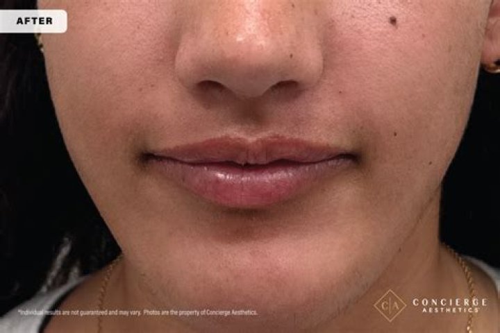Treating &lsquo;MShaped&rsquo; Lips Aesthetics